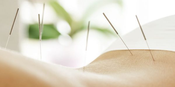 Female back with steel needles during procedure of acupuncture therapy
